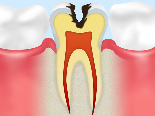 象牙質むし歯（C2）
