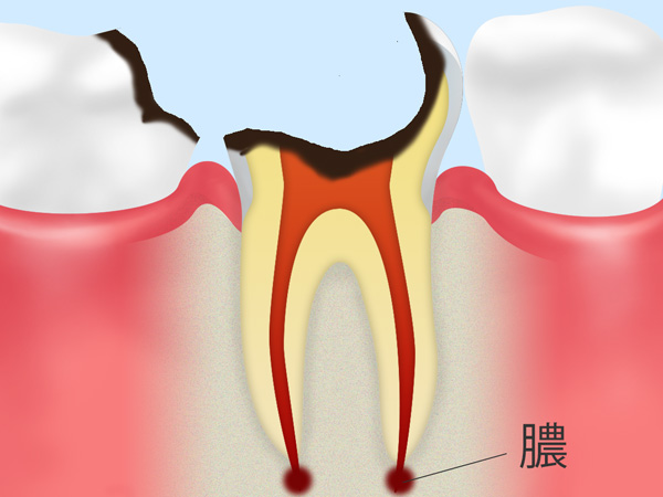歯の根っこしか残らないむし歯（C4）