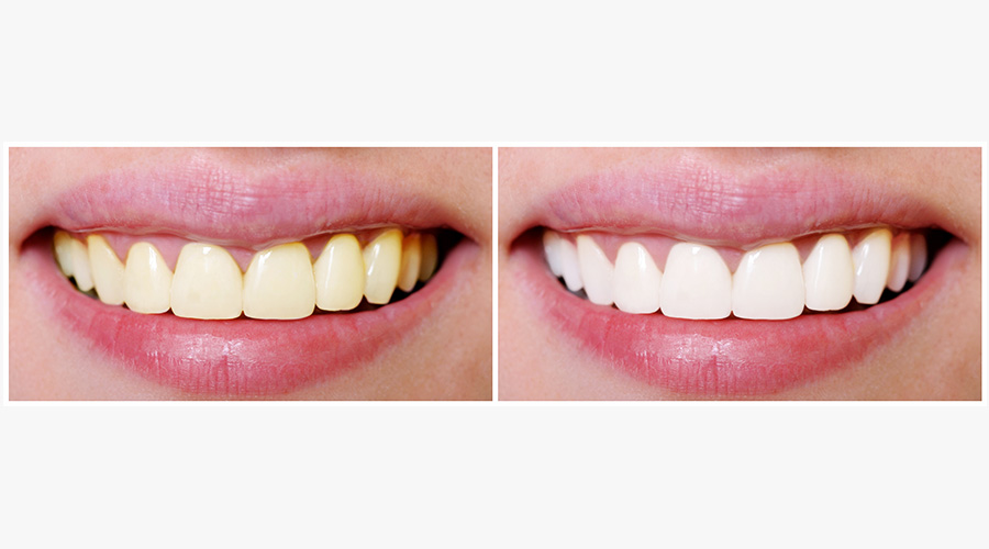 歯の色を改善する『ホワイトニング』